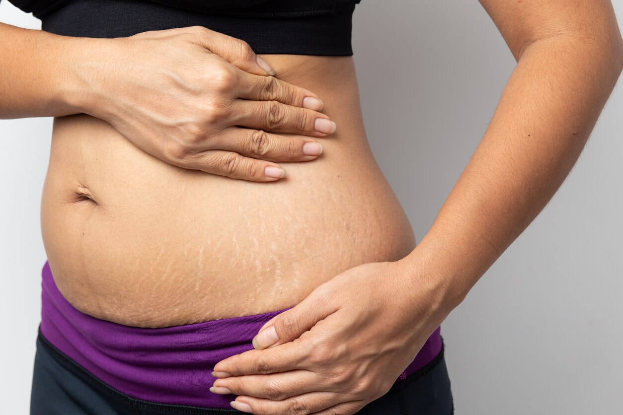 1 an après l'accouchement et ventre gonflé : les solutions